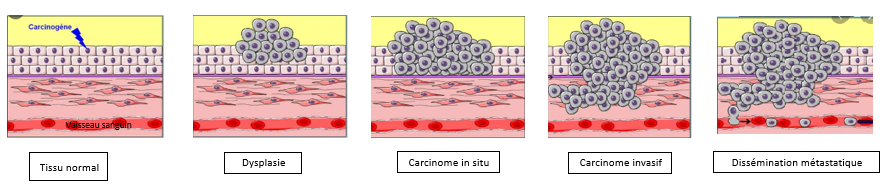 Qu'est-ce qu'un cancer ?