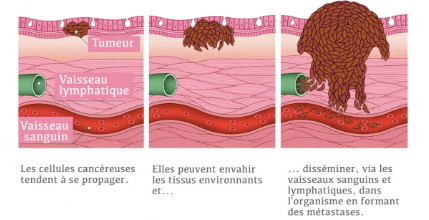 Qu'est-ce que le cancer des os?